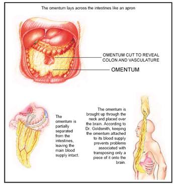 Diet Losing Omentum Fat